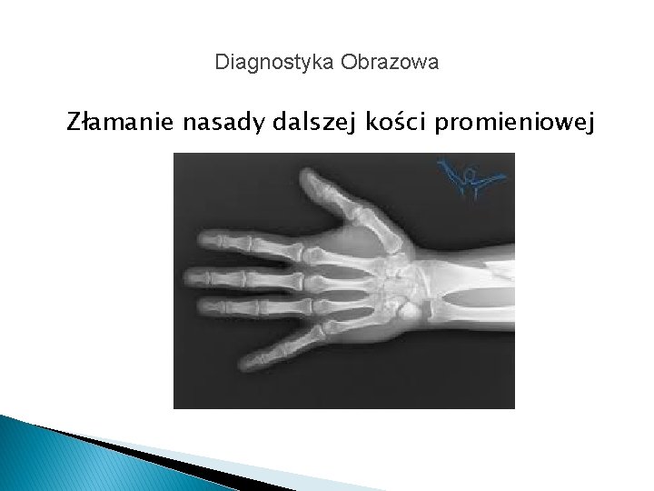 Diagnostyka Obrazowa Złamanie nasady dalszej kości promieniowej 