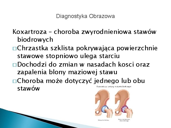 Diagnostyka Obrazowa Koxartroza – choroba zwyrodnieniowa stawów biodrowych � Chrzastka szklista pokrywająca powierzchnie stawowe