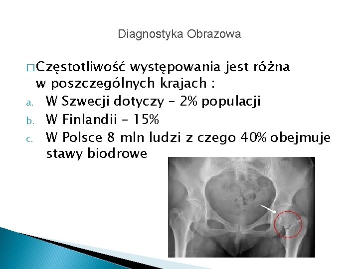 Diagnostyka Obrazowa � Częstotliwość występowania jest różna w poszczególnych krajach : a. W Szwecji