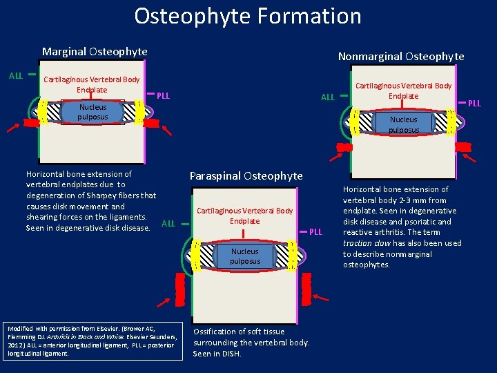 Osteophyte Formation Marginal Osteophyte ALL Cartilaginous Vertebral Body Endplate Nonmarginal Osteophyte PLL ALL Nucleus