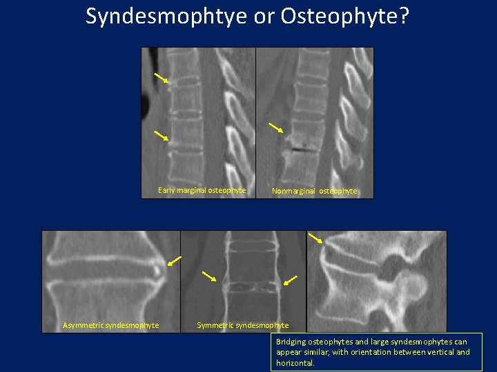 Syndesmophtye or Osteophyte? Early marginal osteophyte Asymmetric syndesmophyte Nonmarginal osteophyte Symmetric syndesmophyte Bridging osteophytes