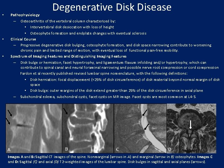 Degenerative Disk Disease Pathophysiology – Osteoarthritis of the vertebral column characterized by: • Intervertebral