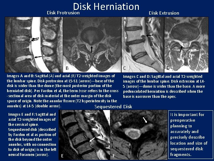 Disk Herniation Disk Protrusion A B C Disk Extrusion D Images A and B: