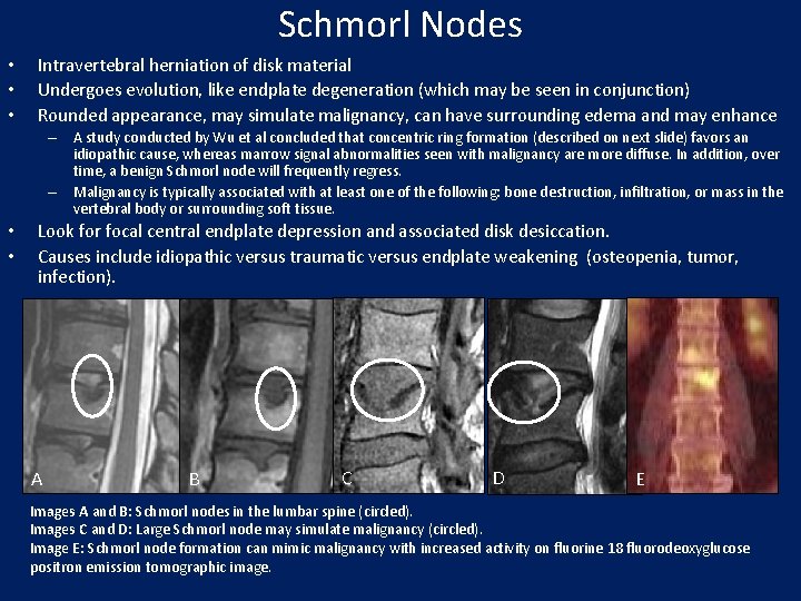 Schmorl Nodes • • • Intravertebral herniation of disk material Undergoes evolution, like endplate