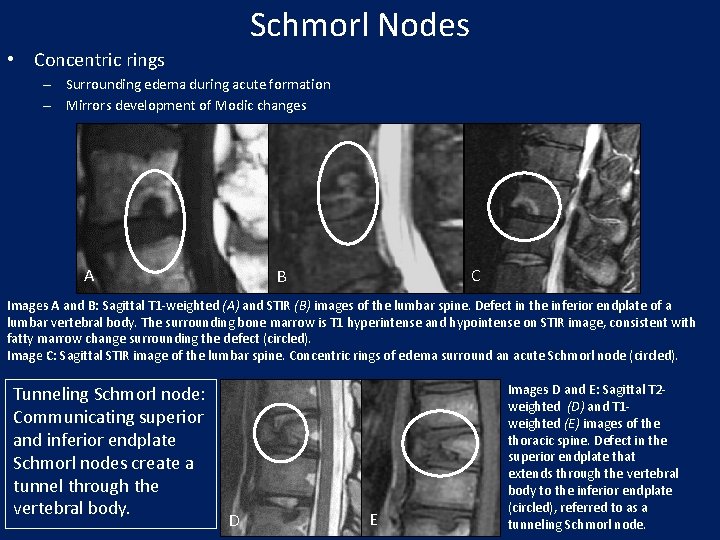 Schmorl Nodes • Concentric rings – Surrounding edema during acute formation – Mirrors development
