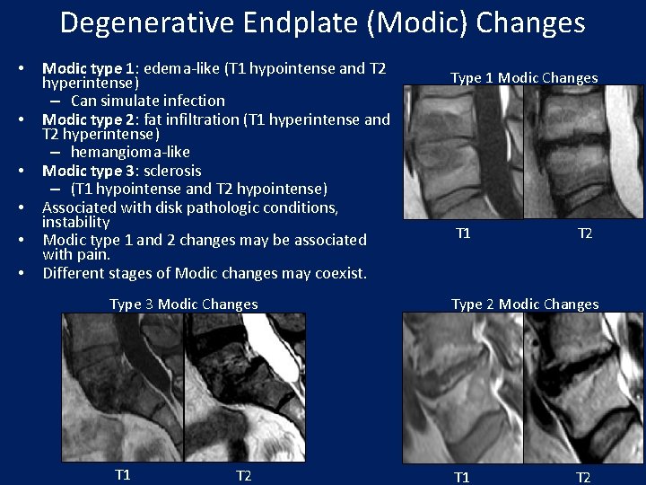 Degenerative Endplate (Modic) Changes • • • Modic type 1: edema-like (T 1 hypointense
