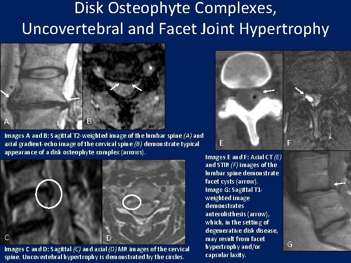 Disk Osteophyte Complexes, Uncovertebral and Facet Joint Hypertrophy A B Images A and B: