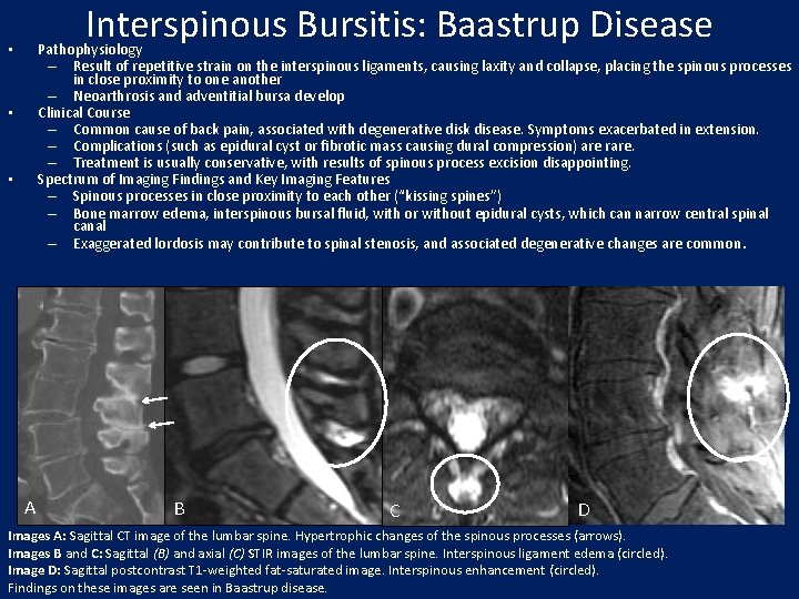 Interspinous Bursitis: Baastrup Disease Pathophysiology – Result of repetitive strain on the interspinous ligaments,