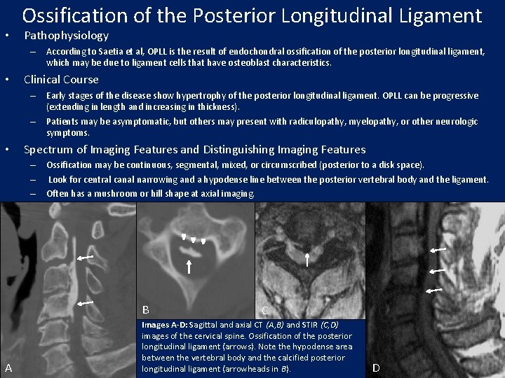  • Ossification of the Posterior Longitudinal Ligament Pathophysiology – According to Saetia et