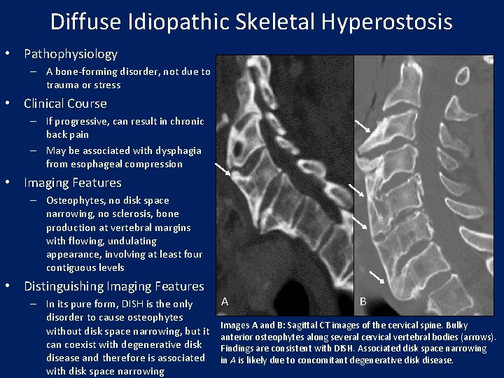 Diffuse Idiopathic Skeletal Hyperostosis • Pathophysiology – A bone-forming disorder, not due to trauma