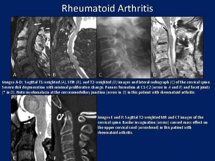 Rheumatoid Arthritis * A B C D * Images A-D: Sagittal T 1 -weighted