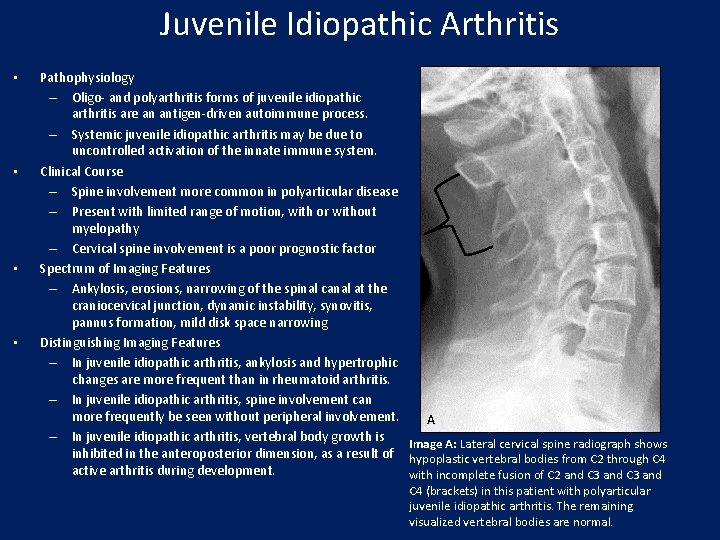 Juvenile Idiopathic Arthritis • • Pathophysiology – Oligo- and polyarthritis forms of juvenile idiopathic