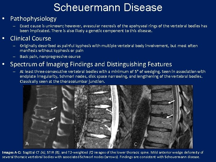 Scheuermann Disease • Pathophysiology – Exact cause is unknown; however, avascular necrosis of the