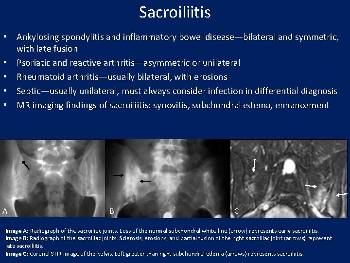 Sacroiliitis • Ankylosing spondylitis and inflammatory bowel disease—bilateral and symmetric, with late fusion •