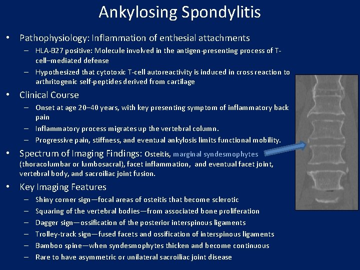 Ankylosing Spondylitis • Pathophysiology: Inflammation of enthesial attachments – HLA-B 27 positive: Molecule involved