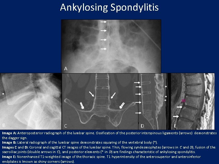 Ankylosing Spondylitis A * * B * * C D E Image A: Anteroposterior