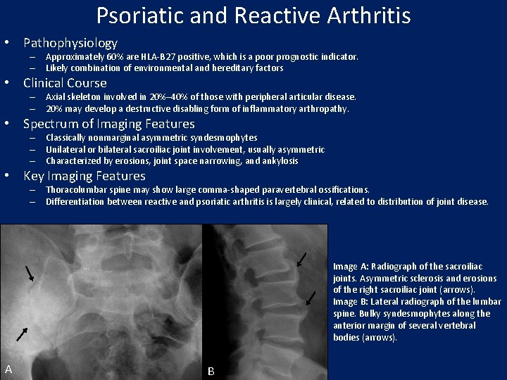 Psoriatic and Reactive Arthritis • Pathophysiology – Approximately 60% are HLA-B 27 positive, which
