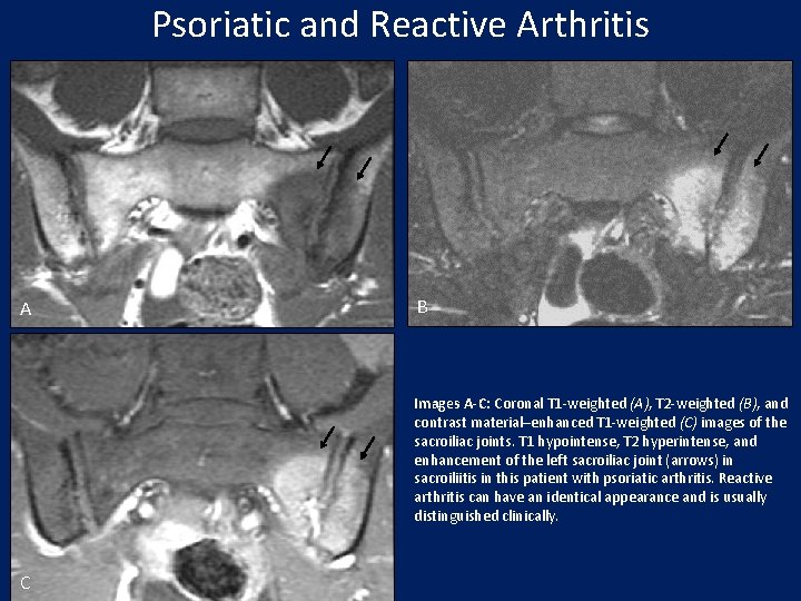 Psoriatic and Reactive Arthritis A B Images A-C: Coronal T 1 -weighted (A), T