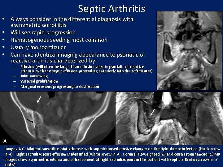 Septic Arthritis • Always consider in the differential diagnosis with asymmetric sacroiliitis • Will