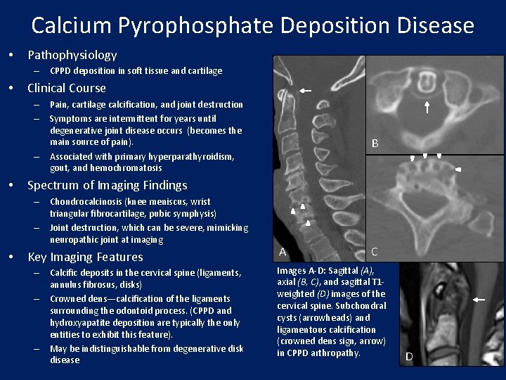 Calcium Pyrophosphate Deposition Disease • Pathophysiology – CPPD deposition in soft tissue and cartilage