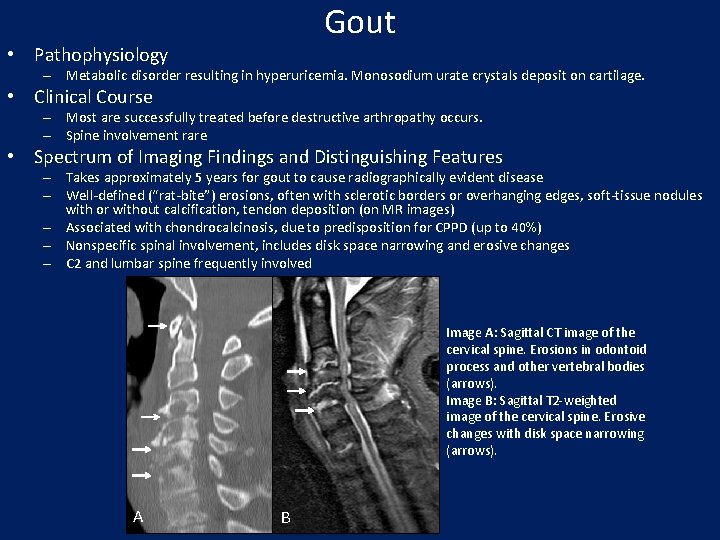 Gout • Pathophysiology – Metabolic disorder resulting in hyperuricemia. Monosodium urate crystals deposit on