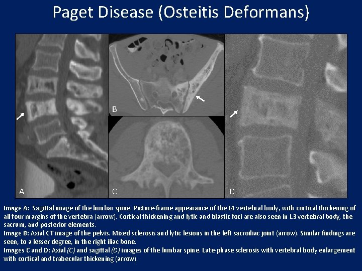 Paget Disease (Osteitis Deformans) B A C D Image A: Sagittal image of the