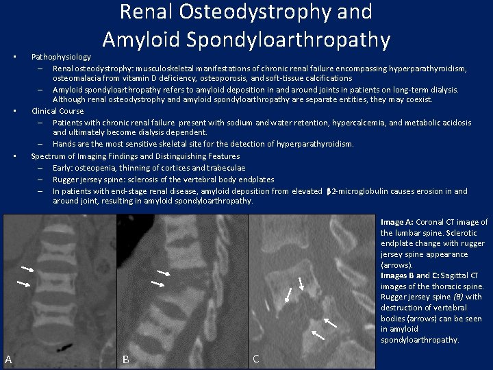  • • • Renal Osteodystrophy and Amyloid Spondyloarthropathy Pathophysiology – Renal osteodystrophy: musculoskeletal
