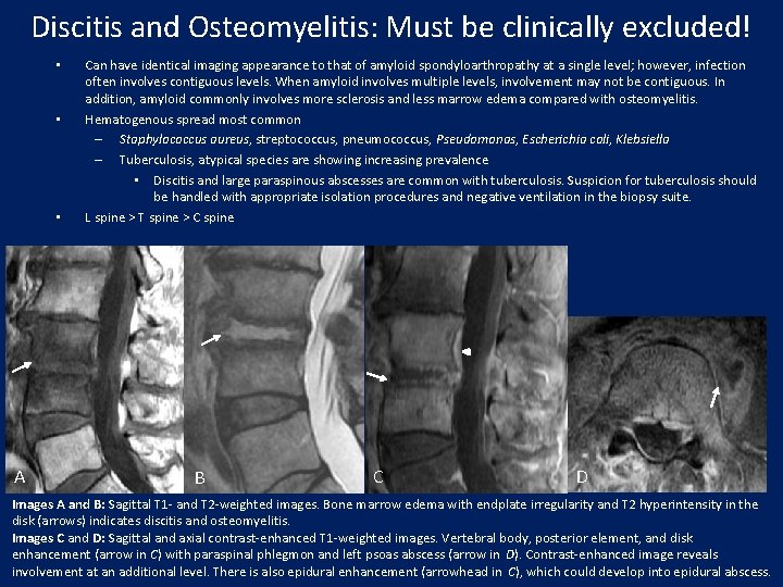 Discitis and Osteomyelitis: Must be clinically excluded! • • • A Can have identical