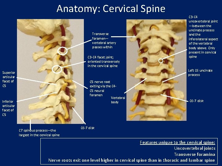 Anatomy: Cervical Spine Transverse foramen— vertebral artery passes within C 3 -C 4 facet