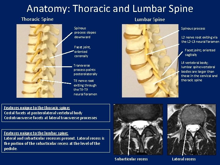 Anatomy: Thoracic and Lumbar Spine Thoracic Spine Lumbar Spine Spinous process slopes downward Spinous