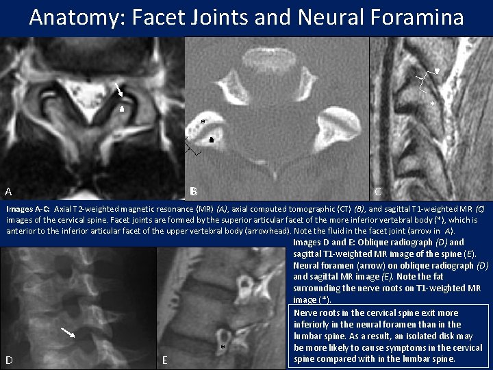 Anatomy: Facet Joints and Neural Foramina * * * B A C Images A-C: