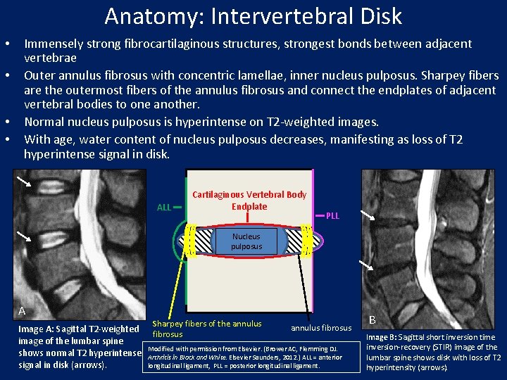 Anatomy: Intervertebral Disk • • Immensely strong fibrocartilaginous structures, strongest bonds between adjacent vertebrae