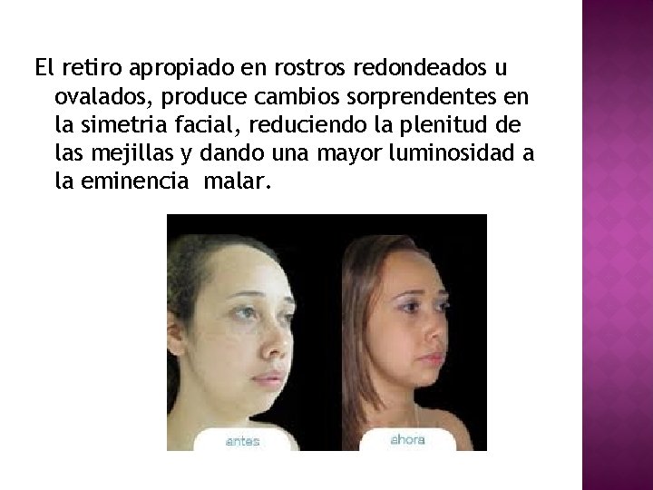 El retiro apropiado en rostros redondeados u ovalados, produce cambios sorprendentes en la simetria