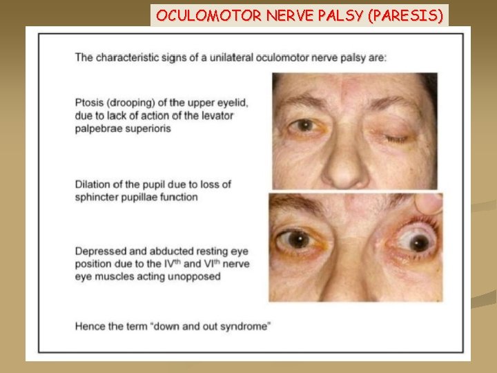 OCULOMOTOR NERVE PALSY (PARESIS) 
