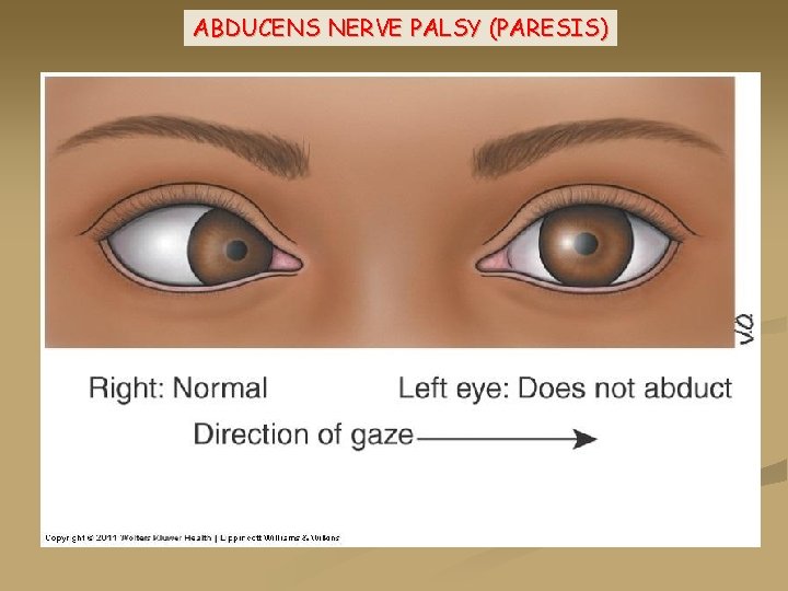 ABDUCENS NERVE PALSY (PARESIS) 