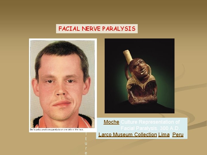 FACIAL NERVE PARALYSIS M o c h e C u l t u r