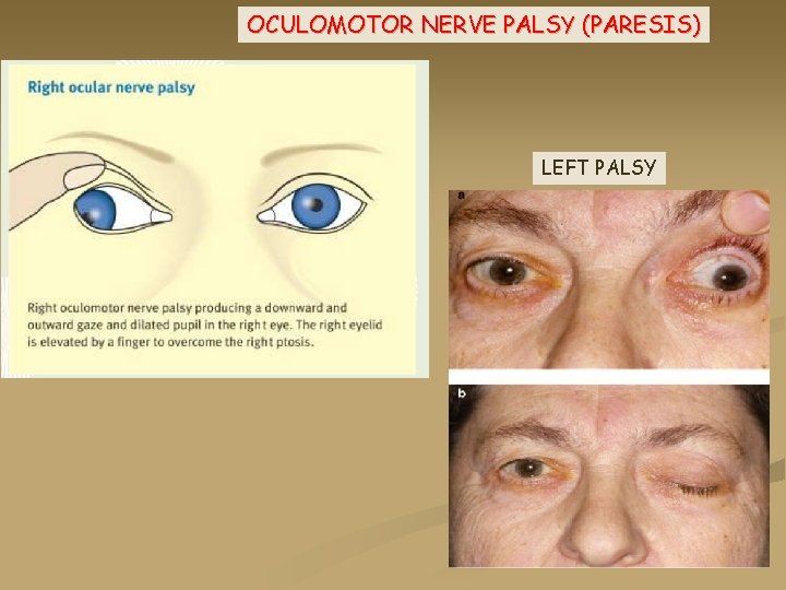 OCULOMOTOR NERVE PALSY (PARESIS) LEFT PALSY 