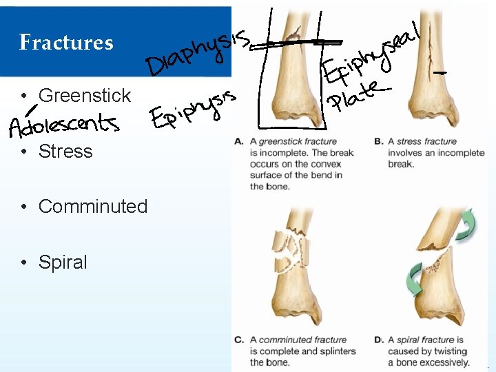 Fractures • Greenstick • Stress • Comminuted • Spiral © Goodheart-Willcox Co. , Inc. Fractures • Greenstick • Stress • Comminuted • Spiral © Goodheart-Willcox Co. , Inc.