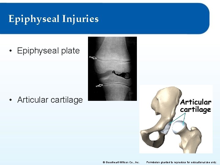 Epiphyseal Injuries • Epiphyseal plate • Articular cartilage © Goodheart-Willcox Co. , Inc. Permission Epiphyseal Injuries • Epiphyseal plate • Articular cartilage © Goodheart-Willcox Co. , Inc. Permission