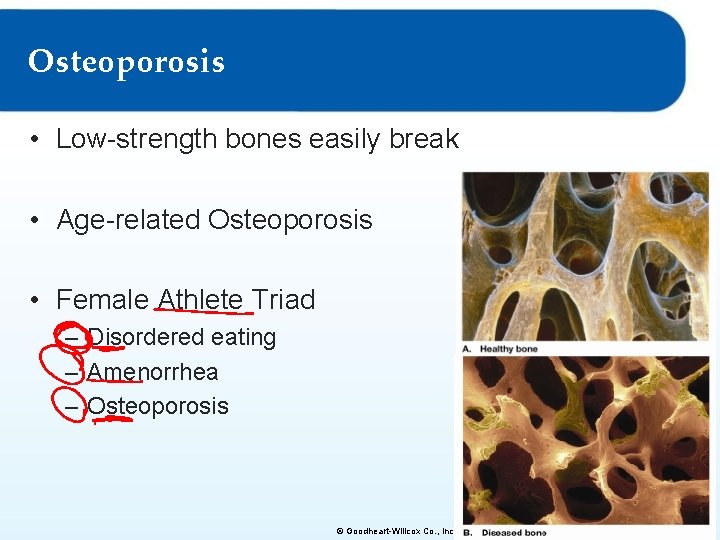 Osteoporosis • Low-strength bones easily break • Age-related Osteoporosis • Female Athlete Triad – Osteoporosis • Low-strength bones easily break • Age-related Osteoporosis • Female Athlete Triad –