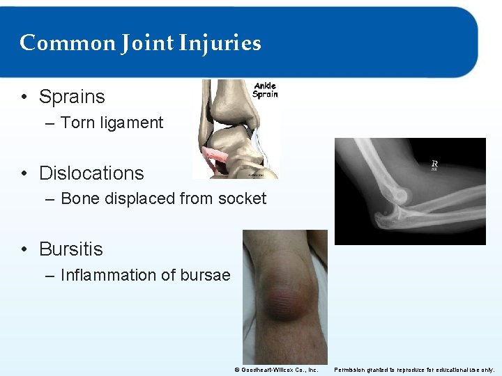 Common Joint Injuries • Sprains – Torn ligament • Dislocations – Bone displaced from Common Joint Injuries • Sprains – Torn ligament • Dislocations – Bone displaced from