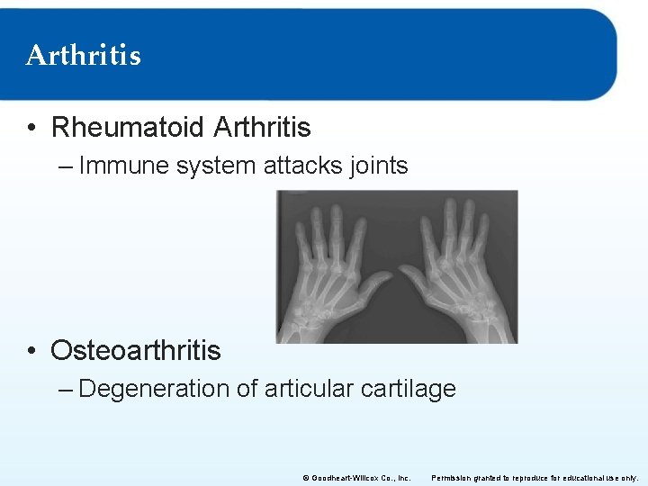 Arthritis • Rheumatoid Arthritis – Immune system attacks joints • Osteoarthritis – Degeneration of Arthritis • Rheumatoid Arthritis – Immune system attacks joints • Osteoarthritis – Degeneration of
