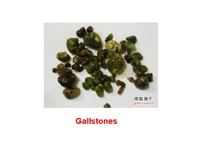 Gallstones 