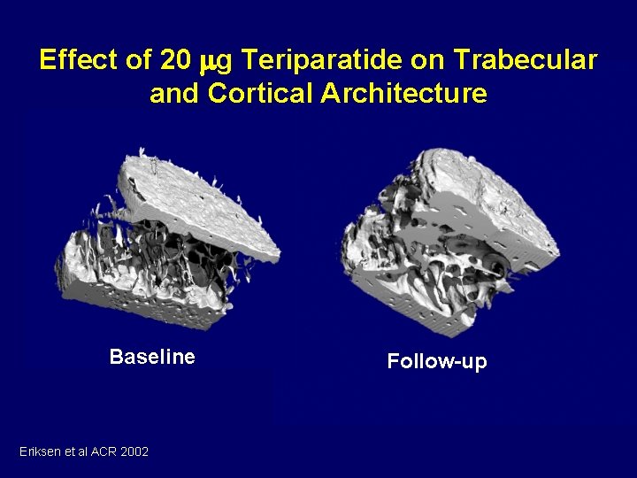 Effect of 20 g Teriparatide on Trabecular and Cortical Architecture Baseline Eriksen et al