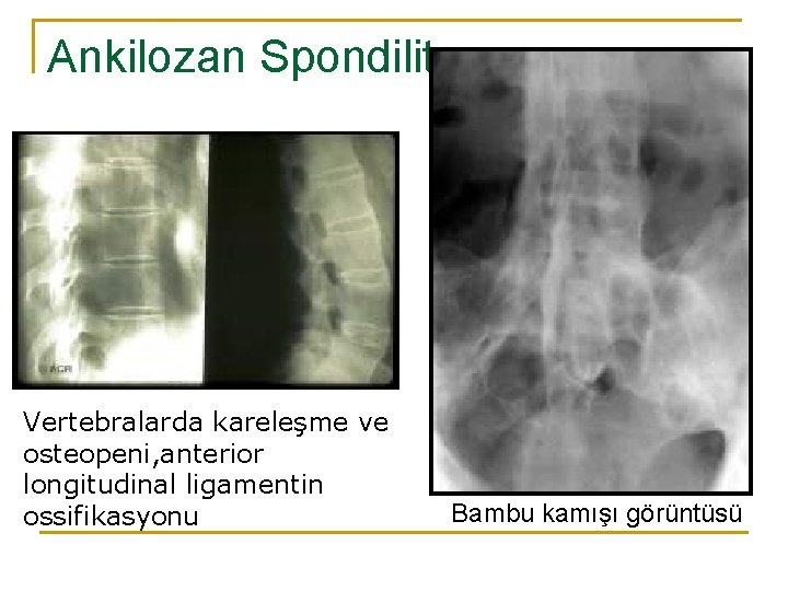 Ankilozan Spondilit Vertebralarda kareleşme ve osteopeni, anterior longitudinal ligamentin ossifikasyonu Bambu kamışı görüntüsü 