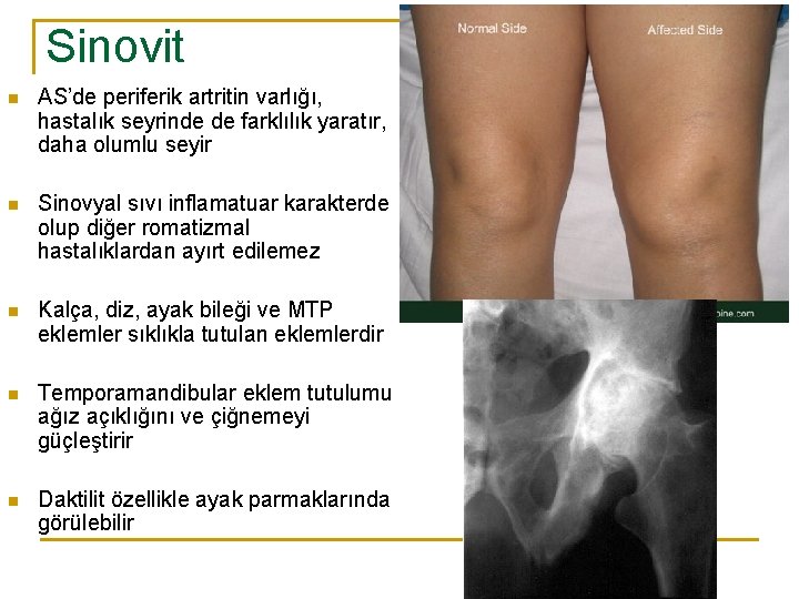 Sinovit n AS’de periferik artritin varlığı, hastalık seyrinde de farklılık yaratır, daha olumlu seyir