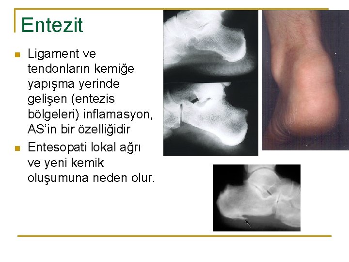 Entezit n n Ligament ve tendonların kemiğe yapışma yerinde gelişen (entezis bölgeleri) inflamasyon, AS’in