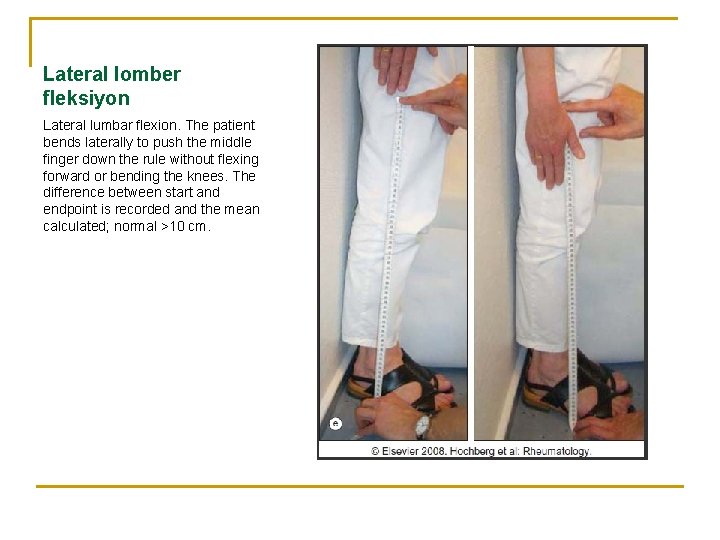 Lateral lomber fleksiyon Lateral lumbar flexion. The patient bends laterally to push the middle