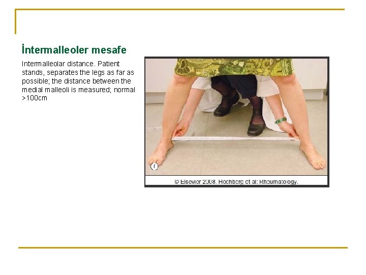 İntermalleoler mesafe Intermalleolar distance. Patient stands, separates the legs as far as possible; the
