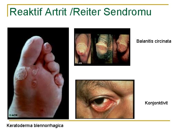 Reaktif Artrit /Reiter Sendromu Balanitis circinata Konjonktivit Keratoderma blennorrhagica 